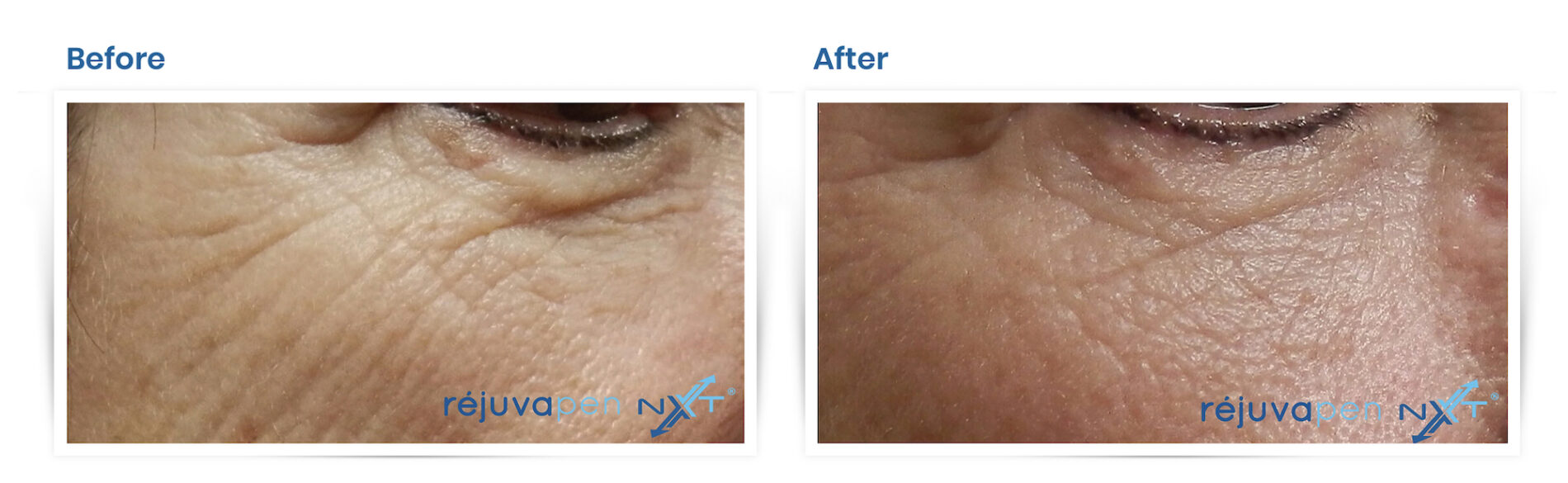 Rejuvapen Microneedling - Restoration Wellness And Medspa